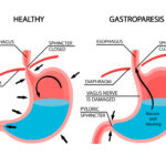 gastroparesis and GLP 1-RA drugs like Ozempic Wegovy and Rybelsus