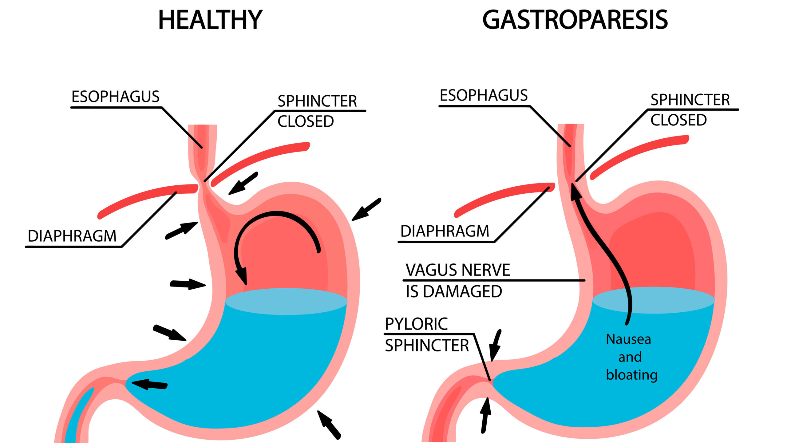 gastroparesis and GLP 1-RA drugs like Ozempic Wegovy and Rybelsus