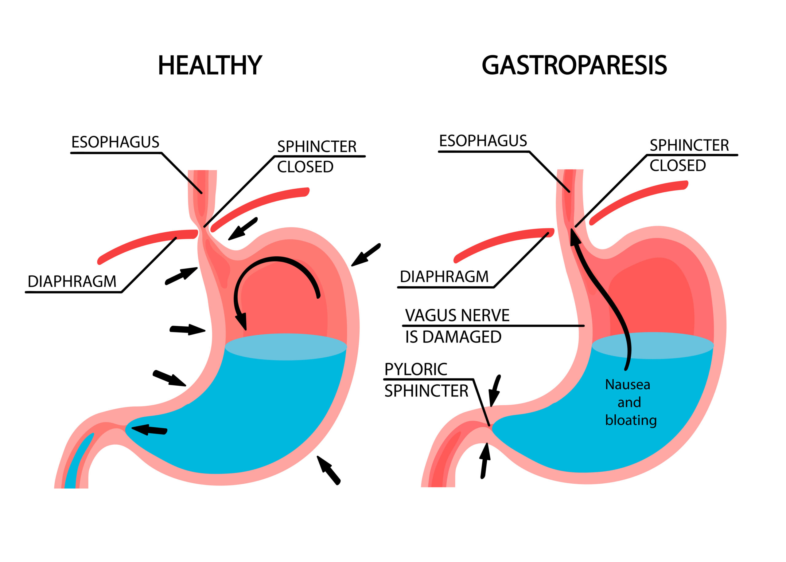 gastroparesis and GLP 1-RA drugs like Ozempic Wegovy and Rybelsus