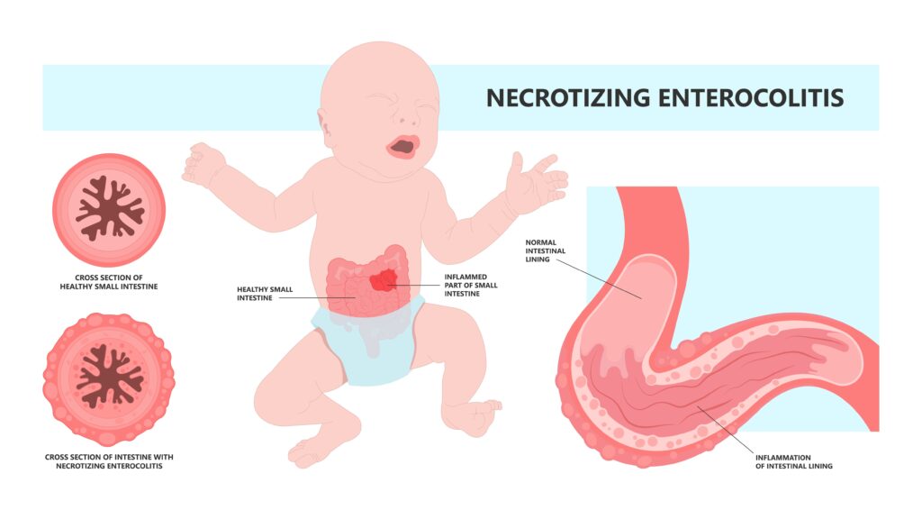 Necrotizing enterocolitis (NEC) in preemie babies from cows milk baby formula