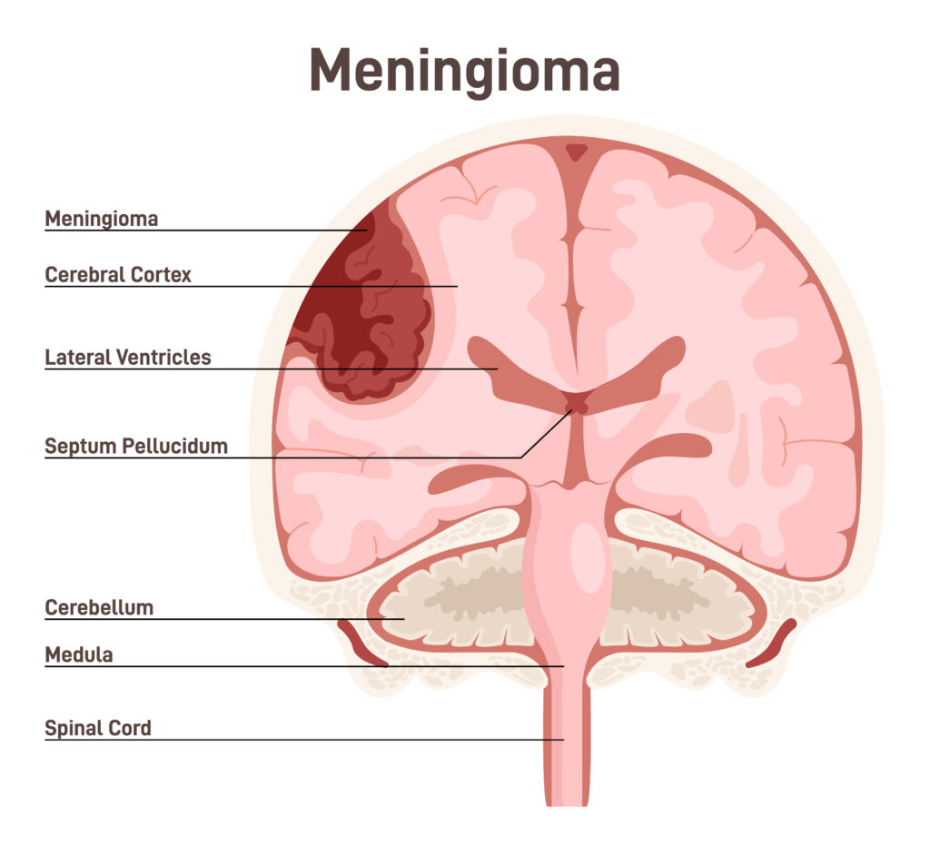 Depo-Provera lawsuit lawyer for Meningioma and brain tumors from injection birth control