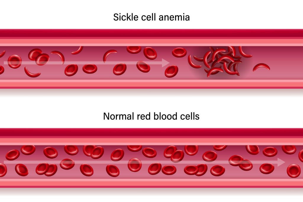 Oxbryta Sickle Cell Disease treatment lawsuit