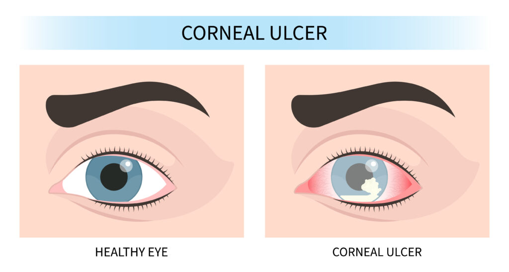 corneal ulcer oxervate lawsuit