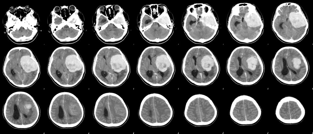 Depo-Provera lawsuit meningioma brain tumor